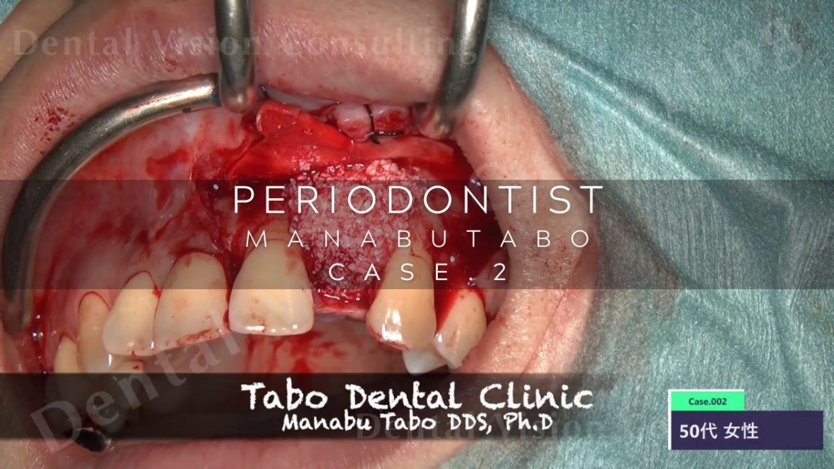 PERIODONTIST MANABUTABO Case.2 GBR/CTG