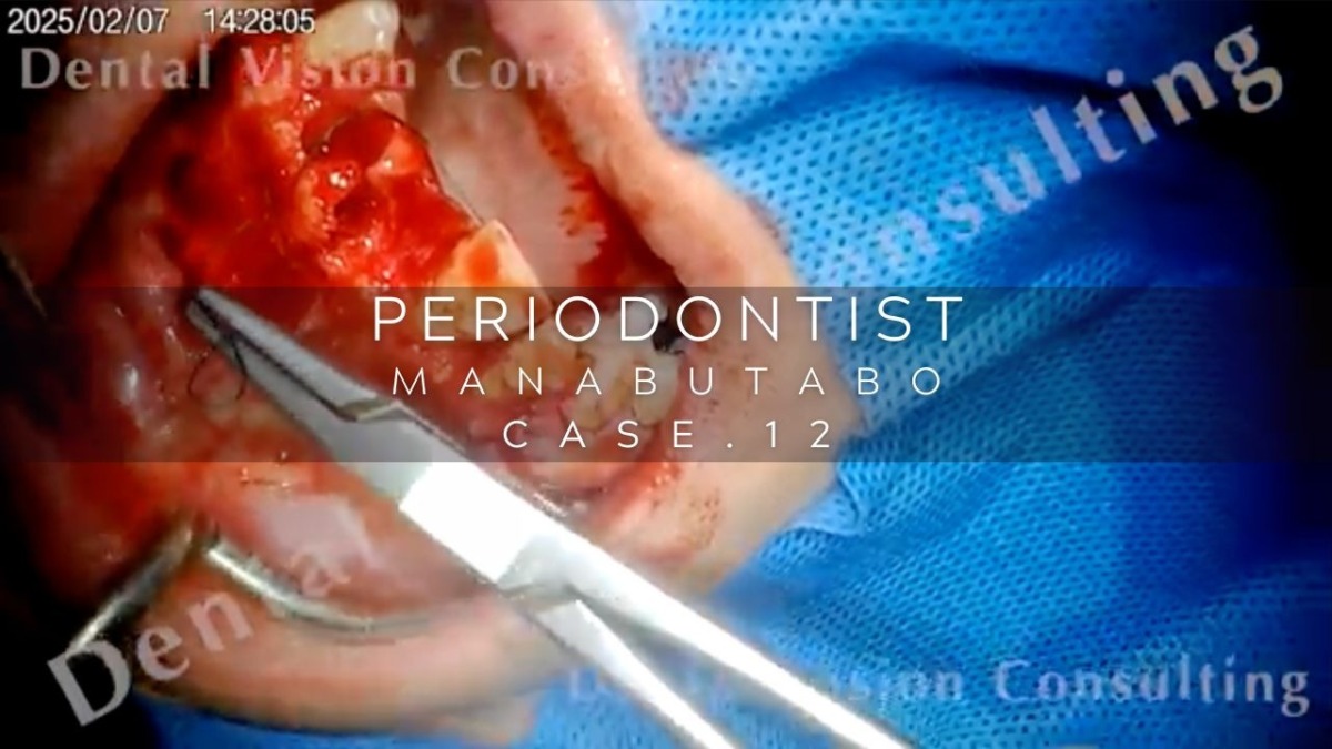 PERIODONTIST MANABUTABO Case.12 IP埋入