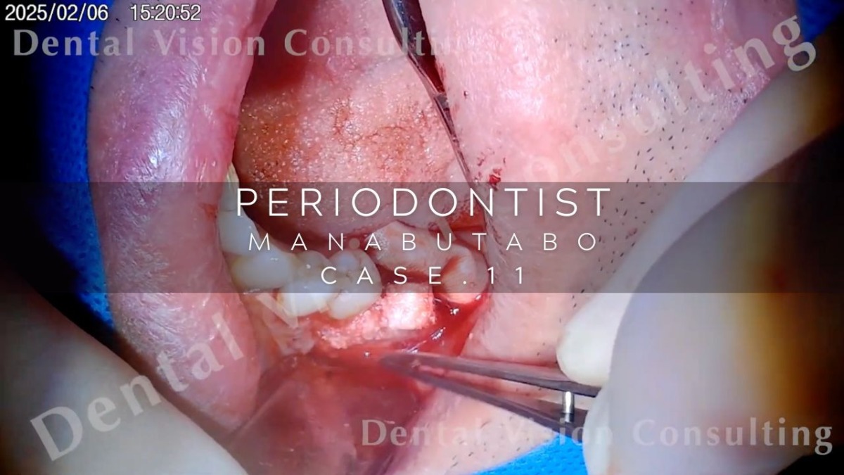 PERIODONTIST MANABUTABO Case.11 両側サイナス