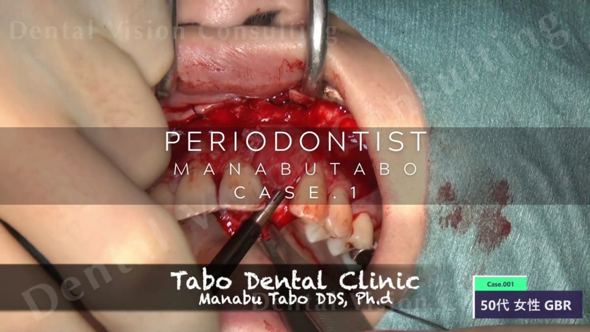 PERIODONTIST MANABUTABO Case.1 GBR