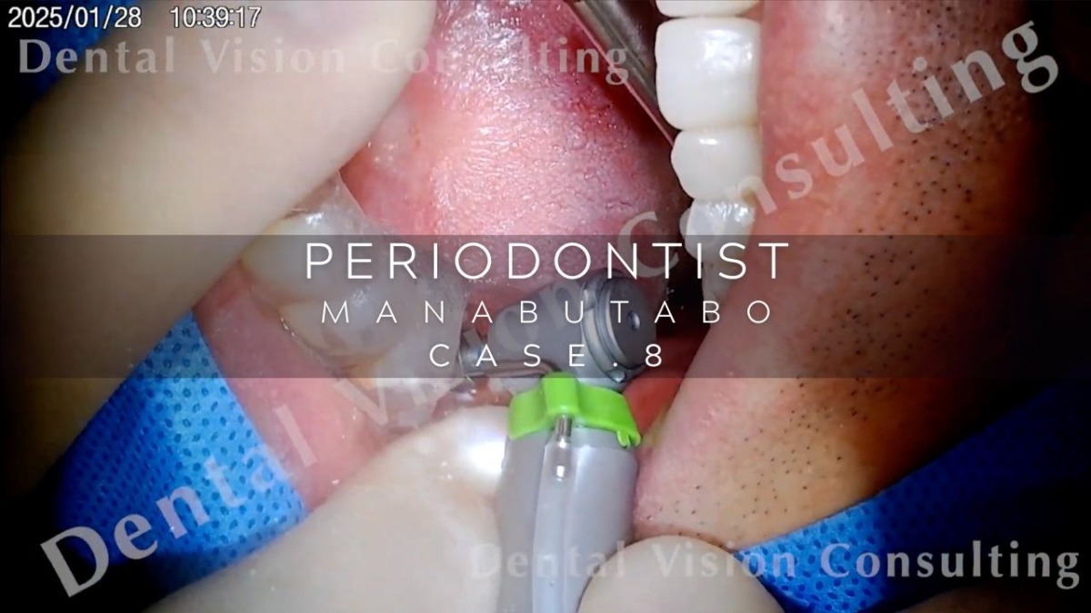 PERIODONTIST MANABUTABO Case.8 MWF