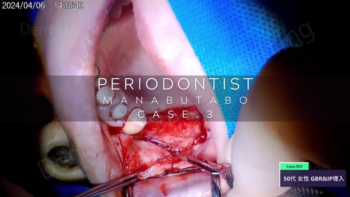 PERIODONTIST MANABUTABO Case.3 GBR