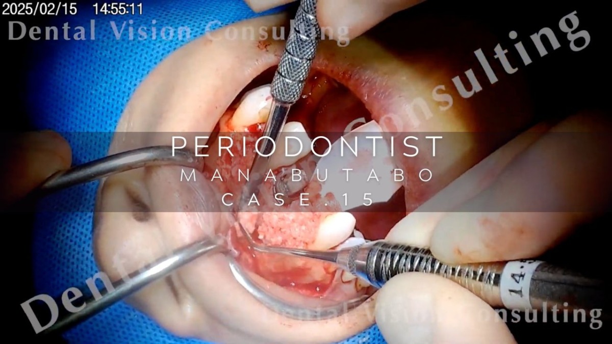 PERIODONTIST MANABUTABO Case.15 IP埋入