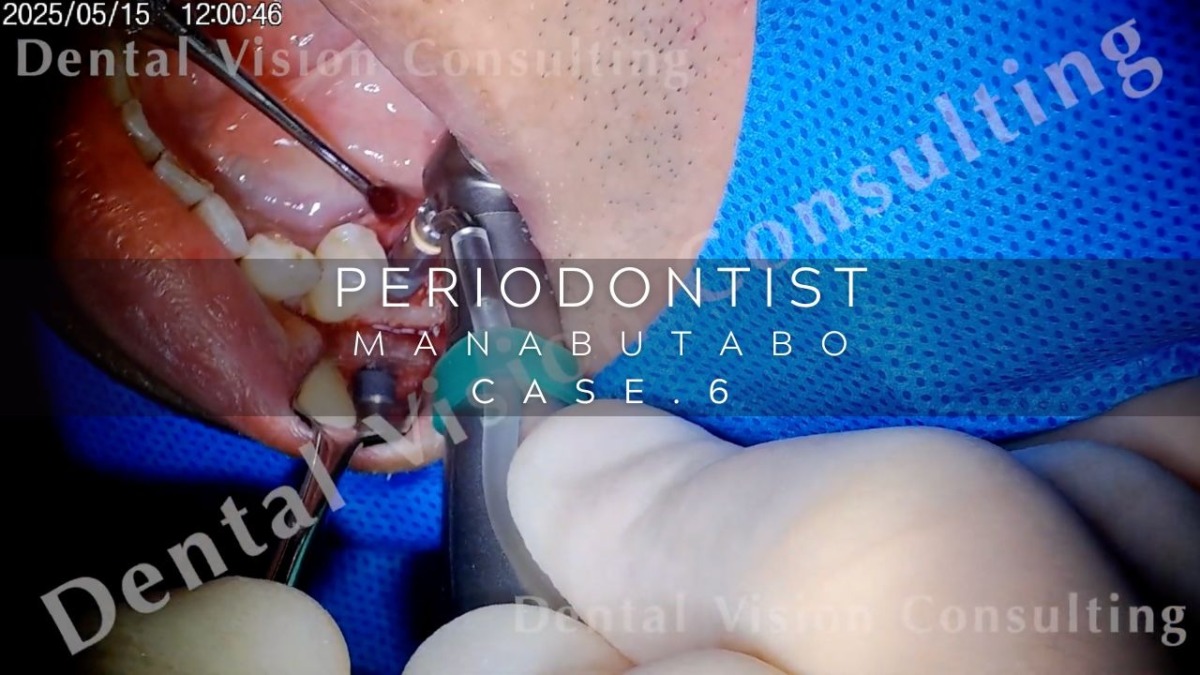 PERIODONTIST MANABUTABO Case.6 GBR