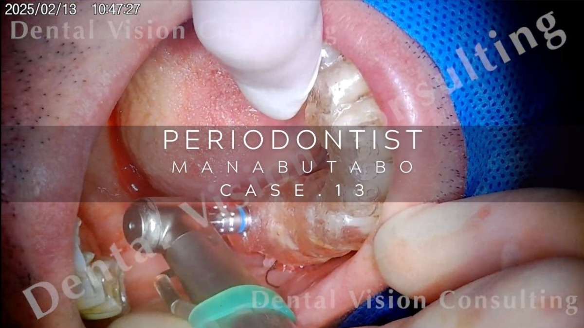 PERIODONTIST MANABUTABO Case.13 GBR