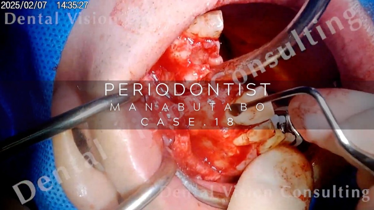 PERIODONTIST MANABUTABO Case.18 GBR