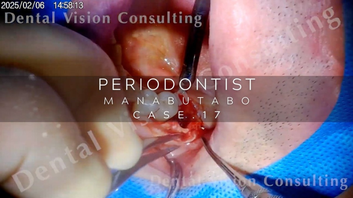 PERIODONTIST MANABUTABO Case.17 ソケプリ
