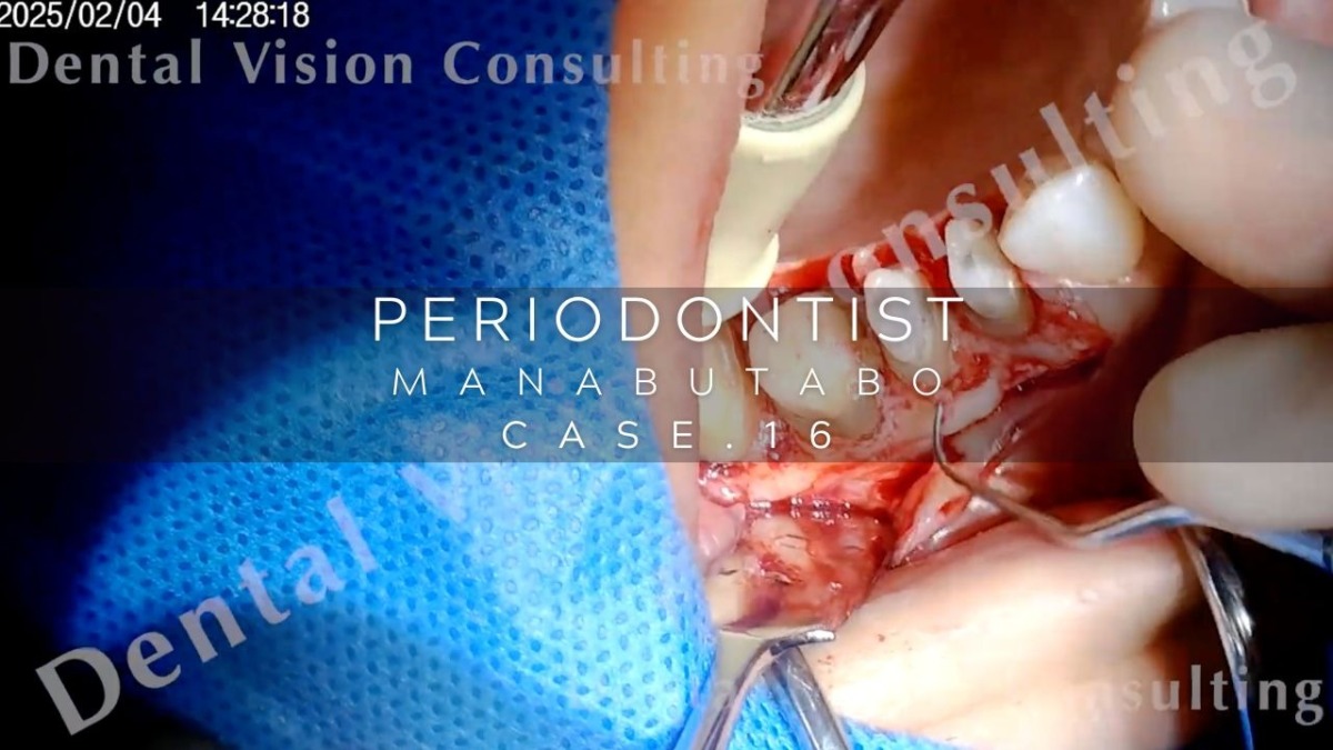 PERIODONTIST MANABUTABO Case.16 APF