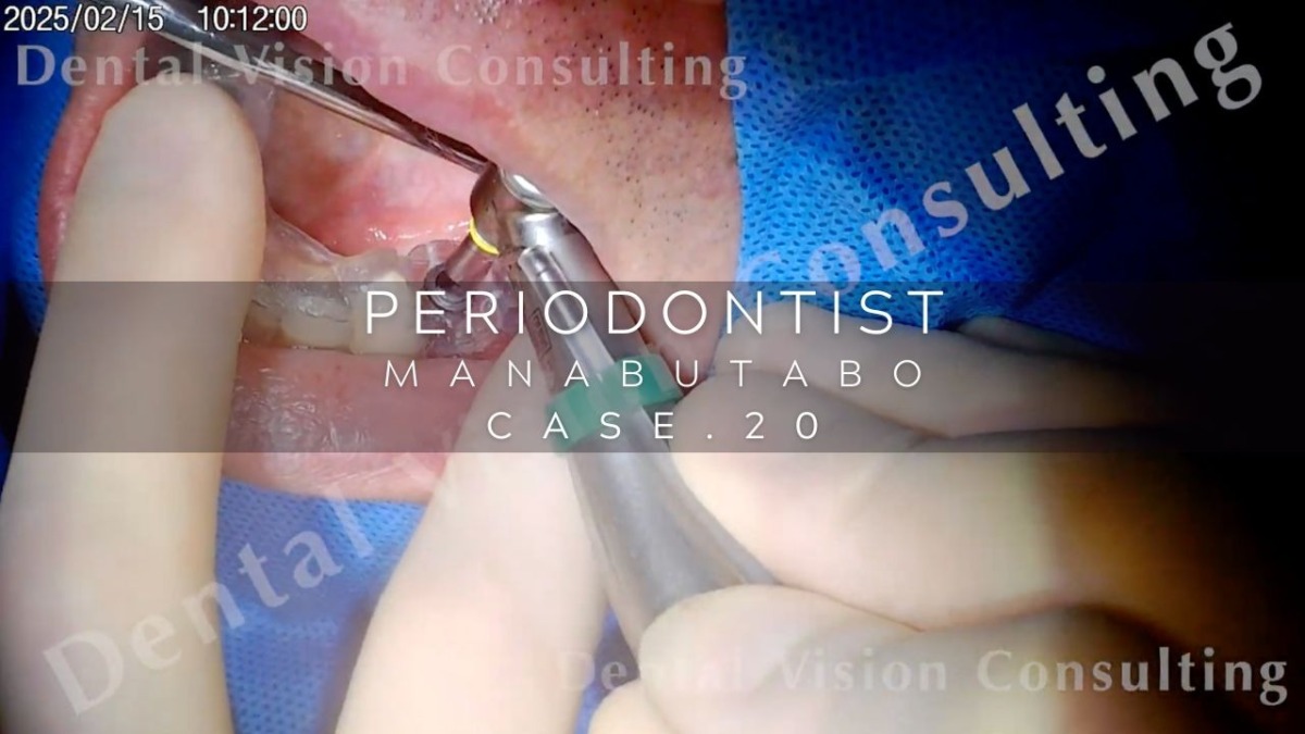 PERIODONTIST MANABUTABO Case.20 IP埋入
