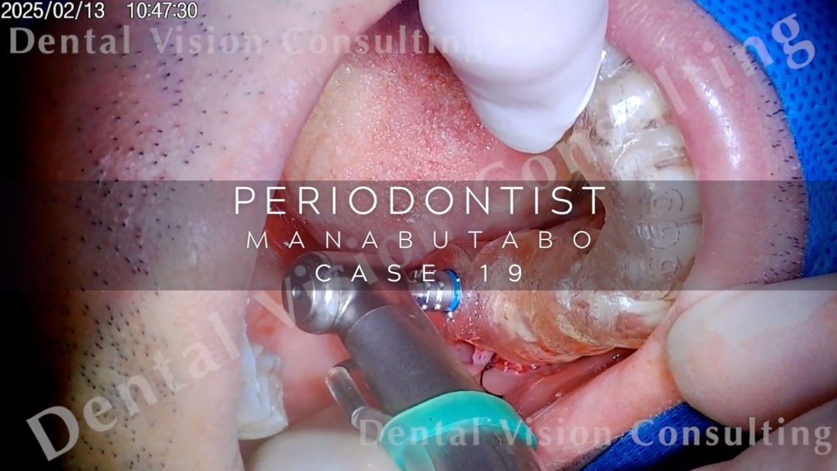 PERIODONTIST MANABUTABO Case.19 IP埋入